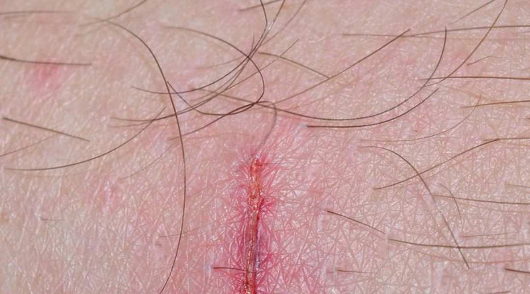 Cómo acelerar la cicatrización de las heridas