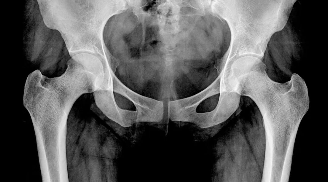 Osteoporosis: qué debemos comer para prevenirla